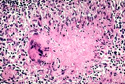 Pathology Outlines Granulomatous Inflammation